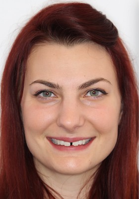 Example of full face photo for cosmetic dental imaging