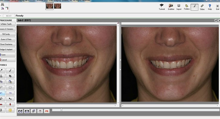 Lip Augmentation